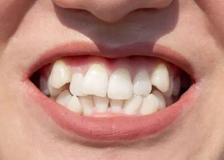 Dientes torcidos
