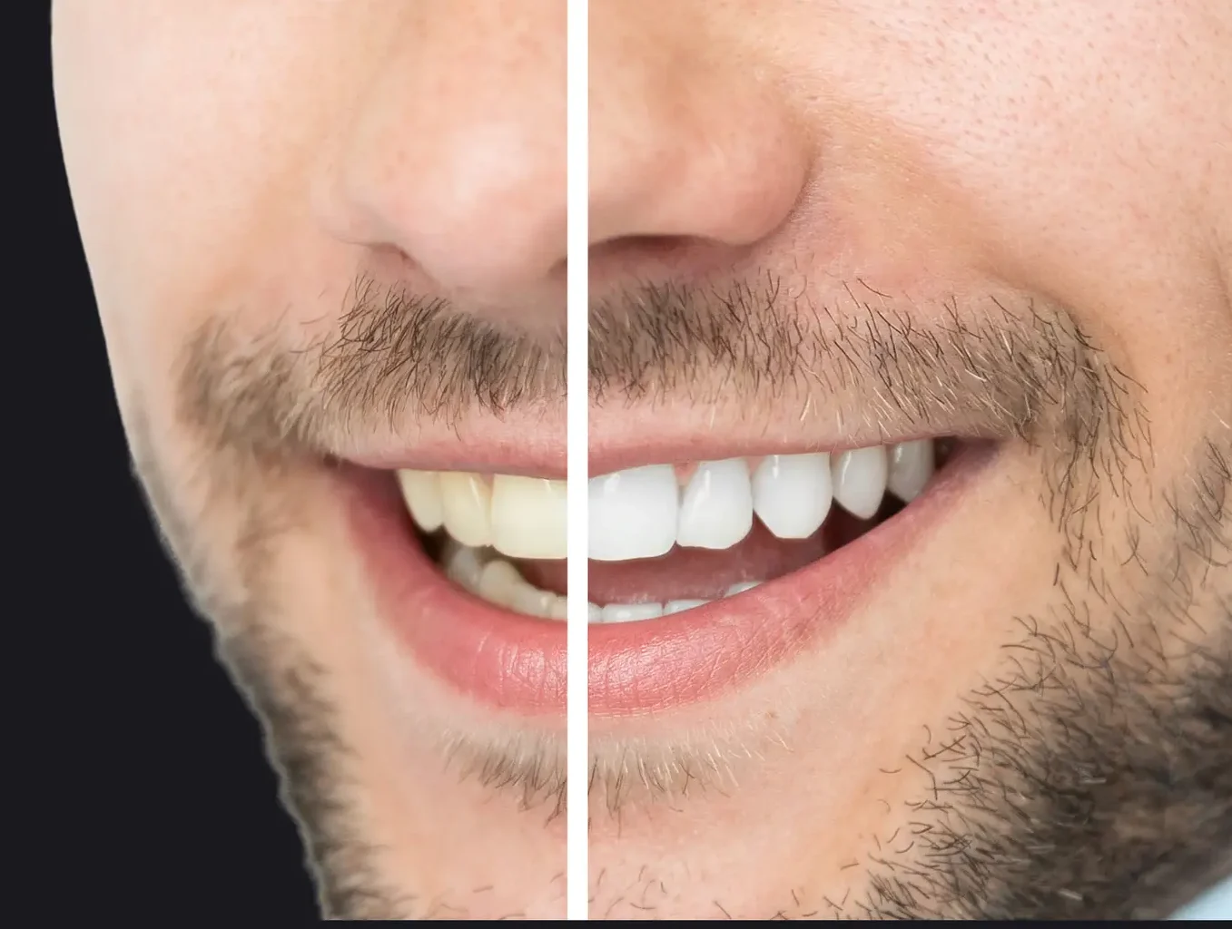Comparación de sonrisa antes y después de limpieza dental, mostrando eliminación de sarro y manchas.