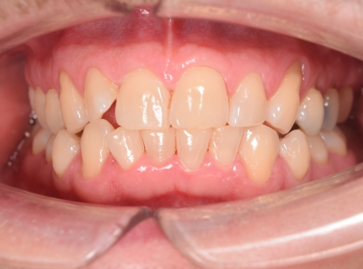 Dientes anteriores limpios sin placa después de limpieza dental profesional en Clínica Dental Cano Miraflores