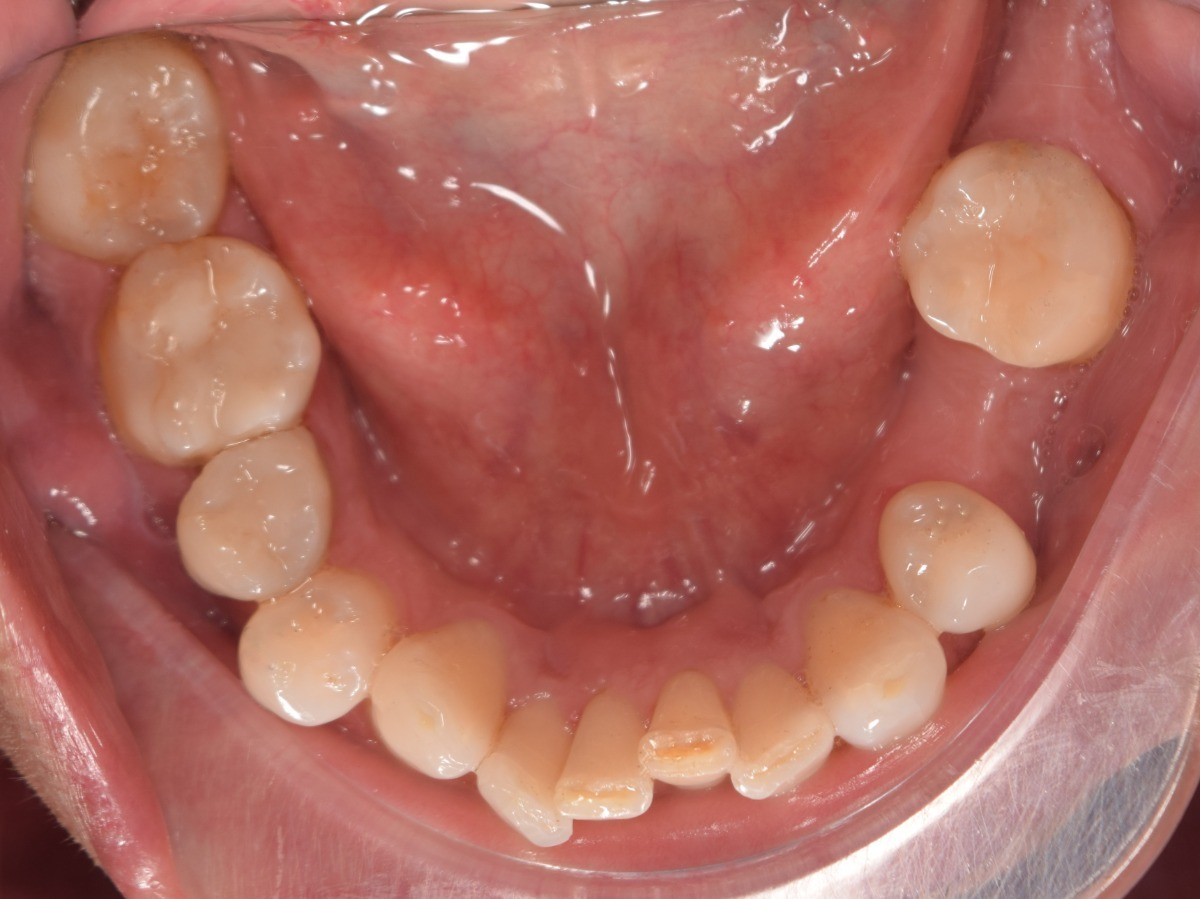 Dientes inferiores limpios después de limpieza dental profesional en Clínica Dental Cano Miraflores sin sarro ni placa