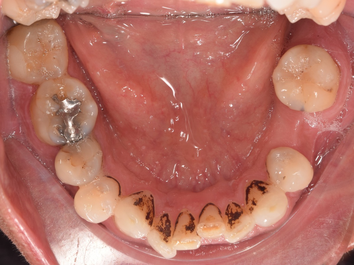 Acumulación de sarro y placa en dientes inferiores antes de limpieza dental profesional en Clínica Dental Cano Miraflores