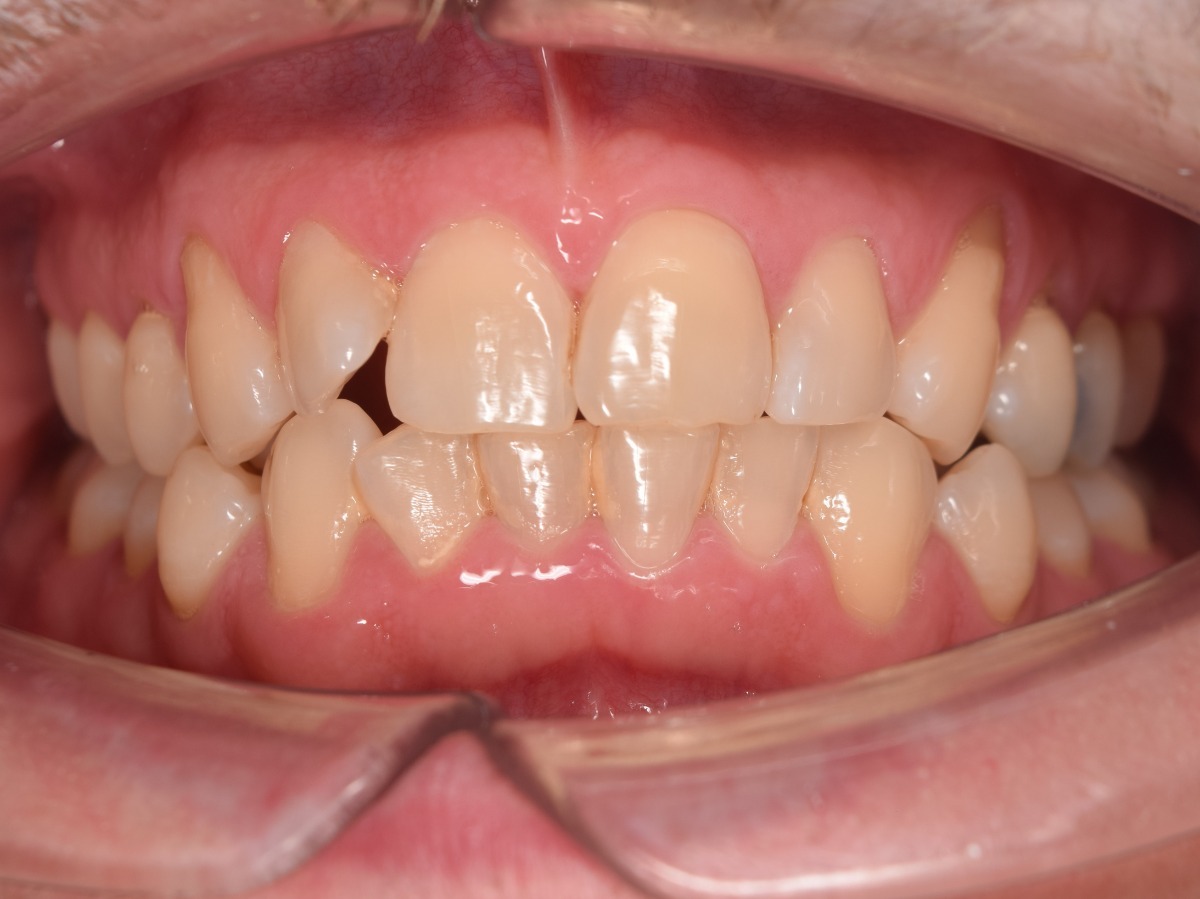 Placa bacteriana visible en dientes anteriores antes de limpieza dental profesional en Clínica Dental Cano Miraflores