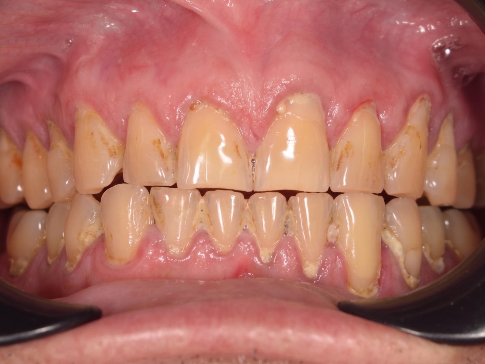 Placa bacteriana y sarro visible en dientes anteriores antes de limpieza dental en Clínica Dental Cano Miraflores