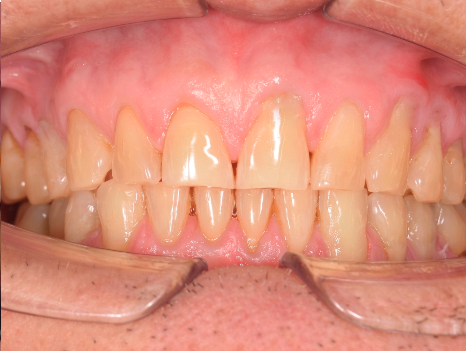 Dientes anteriores limpios y encías saludables después de limpieza dental profesional en Clínica Dental Cano Miraflores